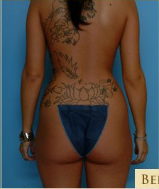 Liposuction Before & After Patient #499