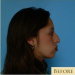 Rhinoplasty Before & After Patient #534