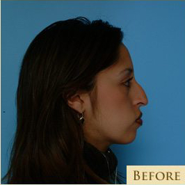 Rhinoplasty Before & After Patient #534