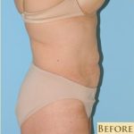 Abdominoplasty Before & After Patient #115