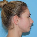 Rhinoplasty Before & After Patient #541