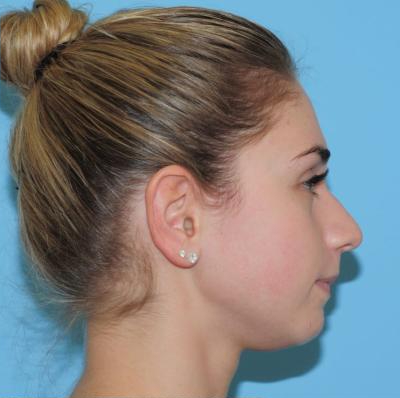 Rhinoplasty Before & After Patient #541