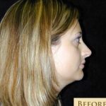 Rhinoplasty Before & After Patient #560