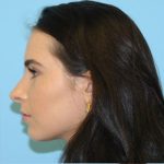 Rhinoplasty Before & After Patient #567