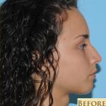 Rhinoplasty Before & After Patient #574