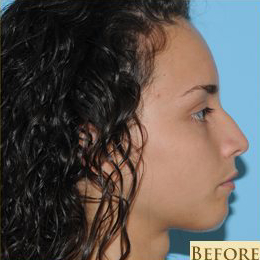 Rhinoplasty Before & After Patient #574