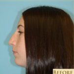 Rhinoplasty Before & After Patient #581