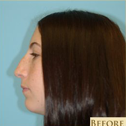 Rhinoplasty Before & After Patient #581