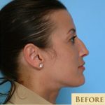 Rhinoplasty Before & After Patient #588
