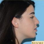 Rhinoplasty Before & After Patient #595