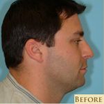 Rhinoplasty Before & After Patient #602