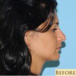 Rhinoplasty Before & After Patient #609