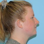 Rhinoplasty Before & After Patient #616