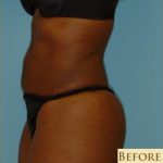 Abdominoplasty Before & After Patient #122