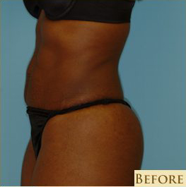 Abdominoplasty Before & After Patient #122