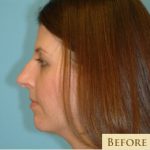 Rhinoplasty Before & After Patient #623