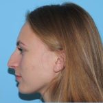 Rhinoplasty Before & After Patient #630