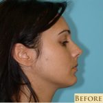 Rhinoplasty Before & After Patient #637