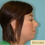 Rhinoplasty Before & After Patient #644