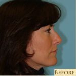 Rhinoplasty Before & After Patient #651