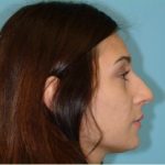 Rhinoplasty Before & After Patient #658