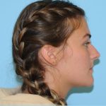 Rhinoplasty Before & After Patient #665