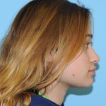 Rhinoplasty Before & After Patient #672
