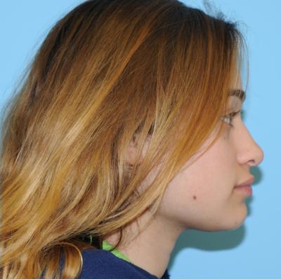 Rhinoplasty Before & After Patient #672