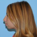 Rhinoplasty Before & After Patient #679