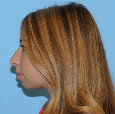 Rhinoplasty Before & After Patient #679