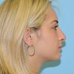 Rhinoplasty Before & After Patient #686