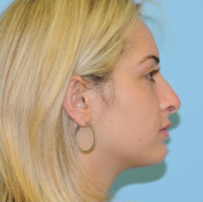 Rhinoplasty Before & After Patient #686