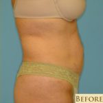 Abdominoplasty Before & After Patient #129