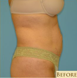 Abdominoplasty Before & After Patient #129