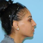 Rhinoplasty Before & After Patient #693