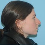 Rhinoplasty Before & After Patient #700