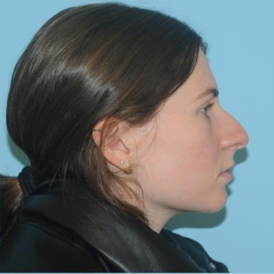 Rhinoplasty Before & After Patient #700
