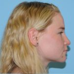 Rhinoplasty Before & After Patient #707