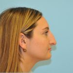 Rhinoplasty Before & After Patient #714