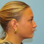 Rhinoplasty Before & After Patient #721