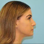 Rhinoplasty Before & After Patient #728
