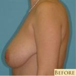 Mastopexy Before & After Patient #735
