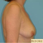 Mastopexy Before & After Patient #742