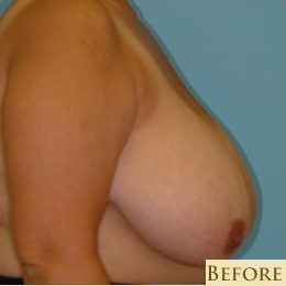 Mastopexy Before & After Patient #749