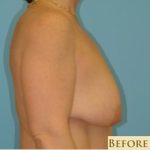 Mastopexy Before & After Patient #756