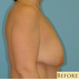 Mastopexy Before & After Patient #756