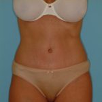 Abdominoplasty Before & After Patient #73