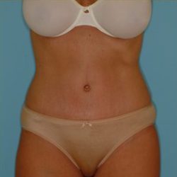 Abdominoplasty Before & After Patient #73