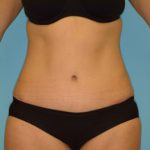 Abdominoplasty Before & After Patient #136