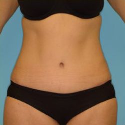 Abdominoplasty Before & After Patient #136